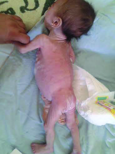 Baby girl admitted to WHO supported SC who was sucessfully treated and discharged 12 days later