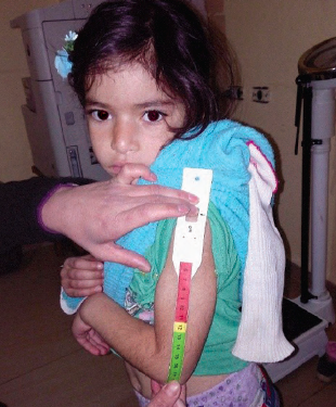Nurse screening for acute malnutrition at the primary healthcare centre