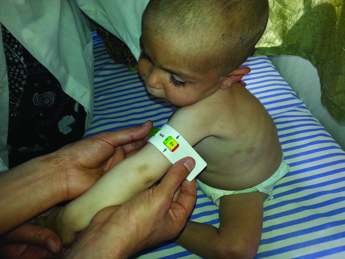 MUAC measurement in an infant